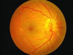 视网膜病