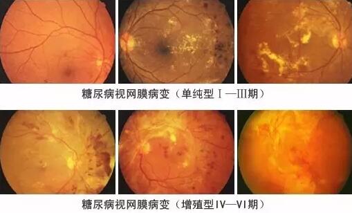 糖尿病引起的眼部并发症有很多，糖尿病视网膜病变(DR)就是其中之一，糖尿病视网膜病变是糖尿病在眼部的一种严重并发症，它对视力有很大危害，如不及时医治，可能造成失明。症状包括视力模糊、阴影、斑点及疼痛。.jpg