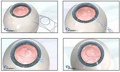 ICL植入术成为目前矫治近视的 技术之一，已在世界范围内被广泛使用。适用范围广， 精度高是ICL植入术较大的特点，可 高达2000度左右近视，600度散光。.jpg