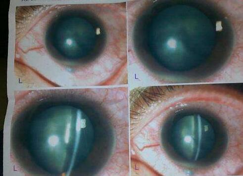 青光眼药物的研发为青光眼药物医治提供了更多的选择，这使青光眼患者获益匪浅，也是许多青光眼患者新的希望。如何为患者选择合适的药物，是当今青光眼医生面临的挑战，而面对多种类型的青光眼药物，如何正确指导患者用药，是 位眼科医师的基本职责.jpg
