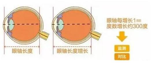 目前主流的摘镜方式有飞秒激光、准分子激光手术、ICL晶体植入术等近视手术方式，不论是高度近视、超高度近视、角膜偏薄患者、干眼患者， 检查合格，都有相应的近视手术 方案。.jpg