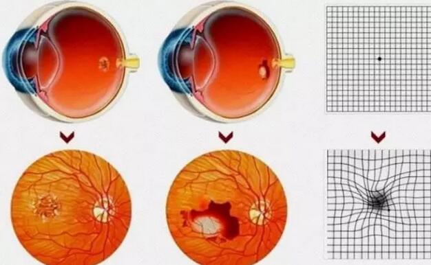 黄斑变性是 的 难医治的眼病之一，目前对于黄斑变性的医治 推的是眼内注射抗VEGF药物，原理是把药物注射到玻璃体腔内，减少VEGF浓度，进而阻止眼病恶化.jpg