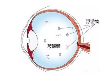 人的眼睛因玻璃体变性引起的小混浊物，随眼球运动引起的视觉干扰，这就是“飞蚊症”，飞蚊症根据出现原因可分为两大类：生理性飞蚊症和病理性飞蚊症1.jpg