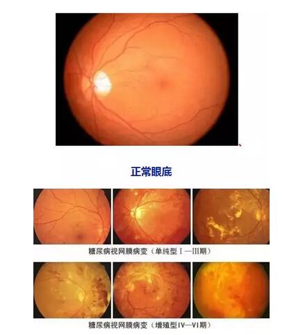 因糖网病几近失明在福州眼科医院进行微创玻切、白内障超乳术后顺利复明2.jpg