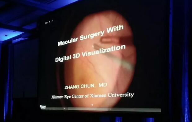 厦门眼科中心张淳教授在第12届亚太玻璃体视网膜学会大会（APVRS2018）上分享利用3D可视化眼科手术系统开展眼底手术2.jpg