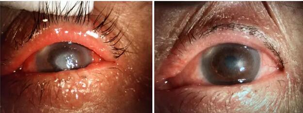 真菌性角膜炎老婆婆求治险被摘眼球 在重庆华厦眼科医院顺利复明2.jpg