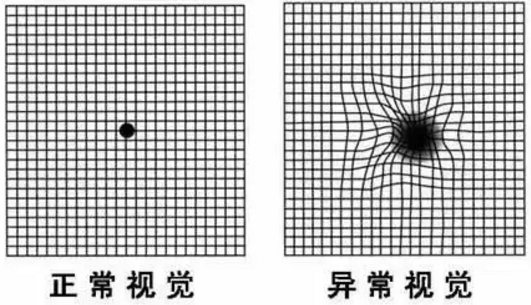 全国失明率第二的疾病——青光眼