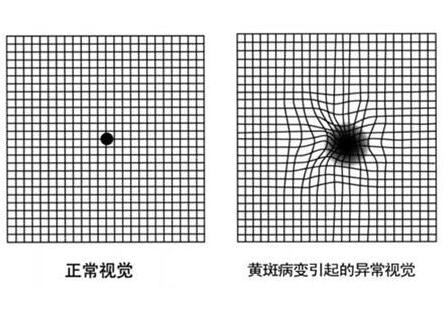 黄斑前膜