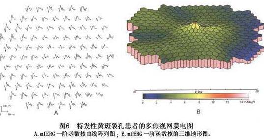 视网膜脱落