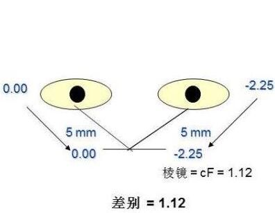 屈光参差