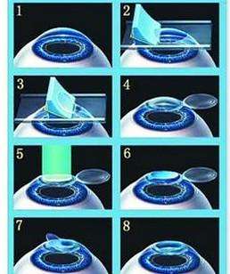 准分子激光手术.jpg