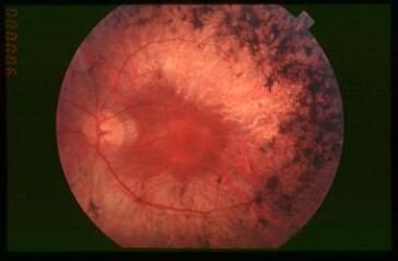 视网膜色素变性.jpg