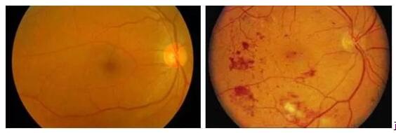 70%的糖尿病患者会出现全身小血管和微血管病变，影响全身组织的供养，进而导致一系列严重的并发症。糖尿病也可以引起一系列眼部疾病，包括白内障、青光眼、眼球运动障碍等，其中较为严重的就是糖尿病视网膜病变，它可以严重影响视力的一种疾病，已经成为四大主要致盲疾病之一。糖尿病引起的失明者比一般人高10到25倍。据有关资料统计，糖尿病患病时间越长，患者出现视网膜病变的比率越大。.jpg
