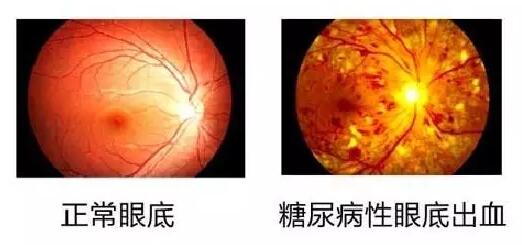  数据表明：糖尿病视网膜病变(简称糖网病)患病率达44%~51.3%，被世界卫生组织认为是仅次于白内障、青光眼的 三致盲眼病。但是不少尤其是基层糖尿病患者，大多数把眼睛的异变误认为是老年人眼花正常现象，从而耽误了病情甚至导致失明。.jpg
