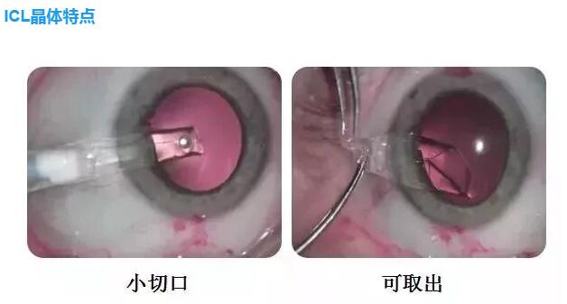 ICL晶体植入术的广泛应用，使得 近视德的屈光手术适用范围更加广泛，除了适用于 普通近视之外，在以往角膜屈光手术难以 的高度近视领域，更是ICL晶体植入术大显身手的地方。2.jpg