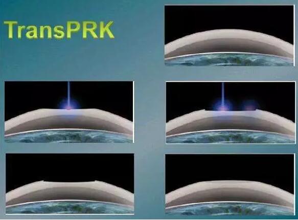全激光TransPRK手术有其无可比拟的优势，但是 一的缺点就是属于表层手术，术后三天需要配戴隐形眼镜等待上皮愈合，在术后当天以及术后早期眼部会有较飞秒较重的不适感， 时间稍慢，一般需要一周到十天才能逐渐 .jpg