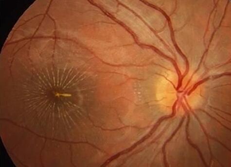 发生在视神经 部位的炎性病变统称为视神经炎，泛指视神经的炎性脱髓鞘、感染、非特异性炎症等疾病。临床根据其受累不同，分为视神经乳头炎和球后视神经炎两大类.jpg