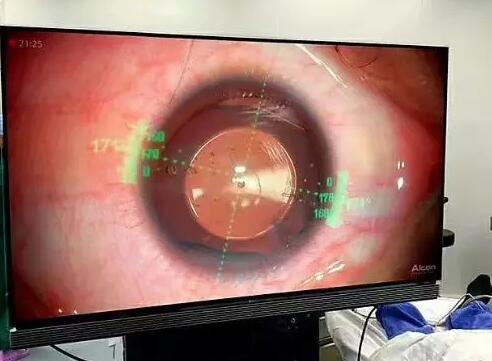 近日，由厦门眼科中心业务副院长张淳博士带领的高度近视专科团队，应用3D导航和2mm微切口技术，仅仅半天时间便顺利完成30台ICL晶体植入手术。据悉，这是在眼科领域 次将3D手术显微镜、术中导航以及2mm微切口三项新技术应用于ICL植入术，标志着厦门眼科中心ICL植入手术处于业界领*水平。2.jpg