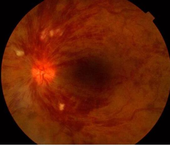 眼底视网膜出血.jpg