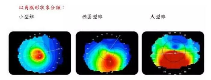 圆锥角膜是一种角膜扩张性疾病，患病后角膜中央或偏中央区域会发生局部变薄向外扩张，导致散光，并随着病情进展逐渐出现视力下降、 不良、视物扭曲变形、虹视等，极大影响生活，严重者可致盲。2.jpg