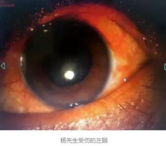 白内障和青光眼都是致盲性眼病，其中青光眼的病程不逆转。杨先生拖延伤情导致同时并发白内障、青光眼的情况，十分令人惋惜。”出名眼科专家、成都华厦眼科医院陈晓明教授表示2.jpg