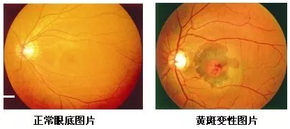 黄斑位于人眼底视网膜的中央，是视力 敏锐的部位，一般医生在测视力时，就是在检查黄斑区的视觉能力。当黄斑区出现异常时，也就是黄斑病变，人的中心视力就会变模糊、变扭曲。.png