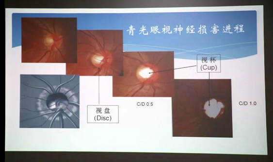 3月10日上午，深圳华厦眼科医院“早查监控，守护光明”大型青光眼公益科普讲座在六楼 举行，本次活动旨在让更多人了解青光眼的潜在危害、重视眼检查， 预防青光眼。由深圳华厦眼科医院青光眼病科 席专家成洪波博士、傅培副院长现场面对面解答疑问，与参会者的互动交流，让更多深圳市民提*对青光眼的认识与防治知识3.png