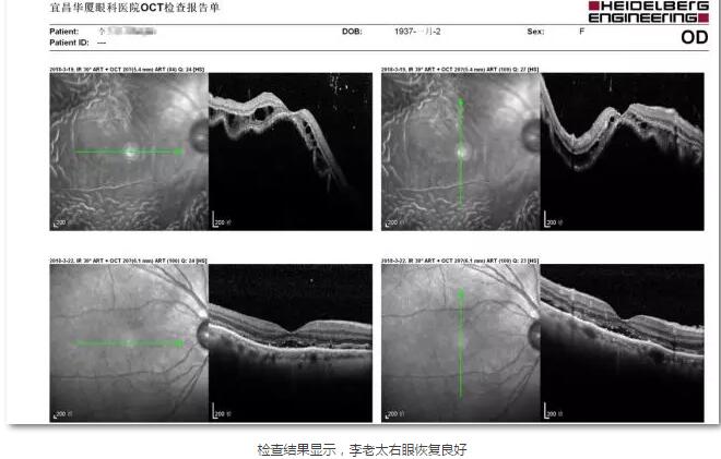 李老太在毫无征兆的情况下右眼视力下降至看不见东西。李老太家人带其至县医院就诊。医生诊断为视网膜脱离，需做玻切手术医治，而玻切手术需要动手术2次。怕疼的李老太一听就犯怵了：开刀，疼。 终，李老太的家人在多方打听后决定带李老太至宜昌华厦眼科医院找许大玲院长医治4.jpg