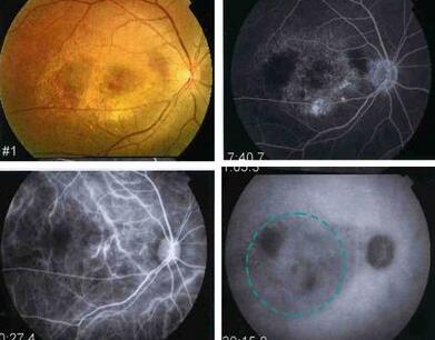 早产儿视网膜病变.jpg