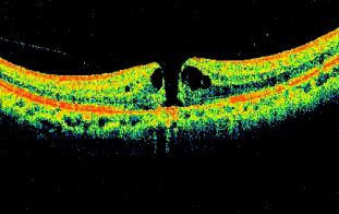 老年人随着年龄增长，黄斑区血管产生异常，黄斑出血、渗出，就损害了视功能，这是很常见的致盲性老年眼病。强烈撞击到眼睛等也会造成黄斑损害或裂孔;由于高度近视造成黄斑裂孔或劈裂等引起严重影响视功能的黄斑病变等。1.jpg
