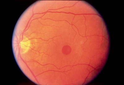 老年人随着年龄增长，黄斑区血管产生异常，黄斑出血、渗出，就损害了视功能，这是很常见的致盲性老年眼病。强烈撞击到眼睛等也会造成黄斑损害或裂孔;由于高度近视造成黄斑裂孔或劈裂等引起严重影响视功能的黄斑病变等。2_副本.jpg