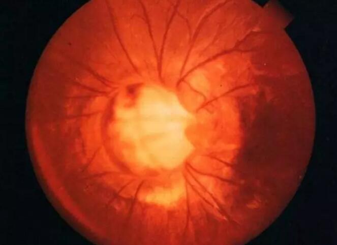 视网膜中央动脉及其分支属于末梢动脉，除了视网膜睫状动脉以外，它是供应视网膜内层营养的 一血管，血液供给障碍都可导致视网膜缺血缺氧，严重损害视功能。因此也称之为视网膜血管阻塞，俗称“眼梗”.jpg