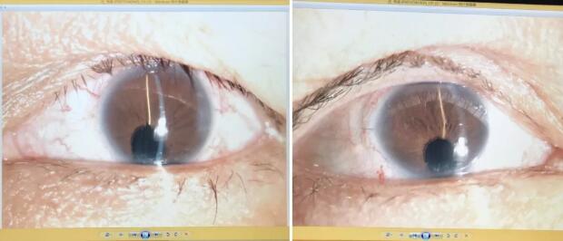 先天性虹膜脉络膜缺损的白内障患者在厦门眼科中心白内障超乳手术后视觉满意2.jpg