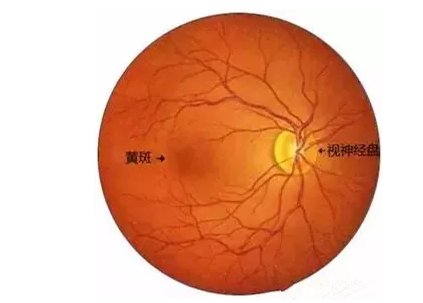 老年黄斑变性其实是眼部黄斑区结构的衰老性改变引起的眼病。“黄斑”是位于视网膜核心区的一个生理结构，一旦黄斑区的视神经细胞被破坏，就会引起患者中心视力下降、视物变形、色暗等1.png