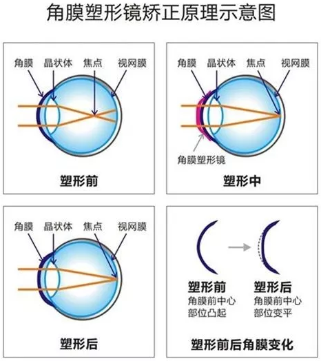 角膜塑形镜是一种硬性透气性隐形眼镜，戴在眼表可使角膜发生塑形效应，从而达到 近视度数的 。适合夜晚睡觉时配戴，白天不用戴眼镜就可以 裸眼视力，不影响学习、运动.png