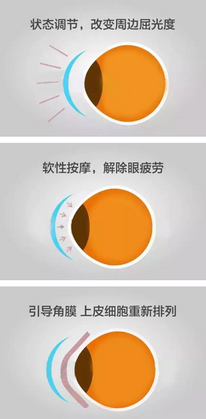 角膜塑形镜是一种硬性透气性隐形眼镜，戴在眼表可使角膜发生塑形效应，从而达到 近视度数的 。适合夜晚睡觉时配戴，白天不用戴眼镜就可以 裸眼视力，不影响学习、运动2.png