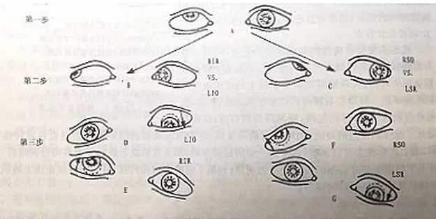 麻痹性斜视医治方法.png