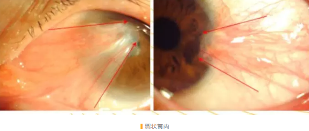 一家两人同日在漳州眼科医院顺利进行翼状胬肉手术2.png