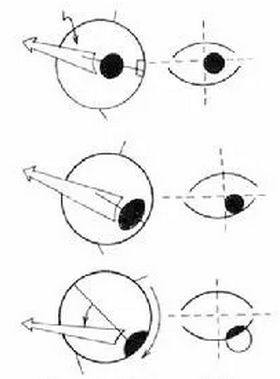 眼球后退综合症的类型与医治方式1.png