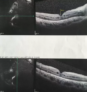 葡萄膜炎等多种眼底病患者跪地感谢深圳华厦眼科医院院长赵铁英教授2.png