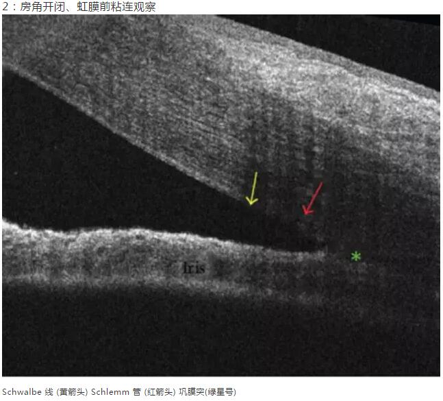 华厦眼科课堂：后节频域OCT前节模块的运用12.jpg