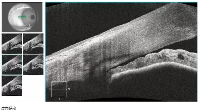 华厦眼科课堂：后节频域OCT前节模块的运用13.jpg
