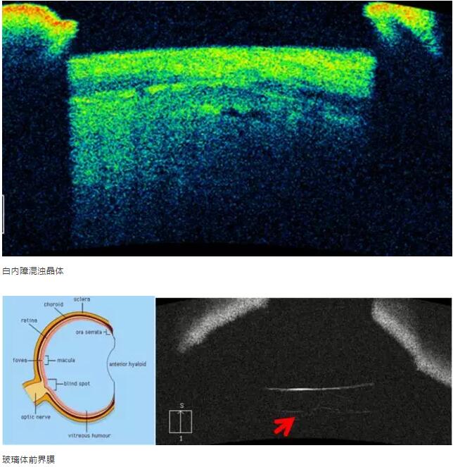 华厦眼科课堂：后节频域OCT前节模块的运用14.jpg