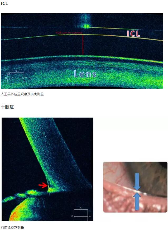 华厦眼科课堂：后节频域OCT前节模块的运用15.jpg