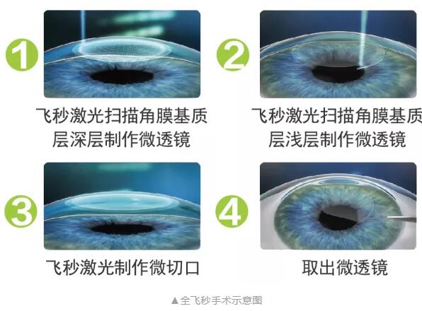 主流近视手术包含全飞秒激光手术、Smart全激光手术、半飞秒激光手术、晶体植入手术1.jpg