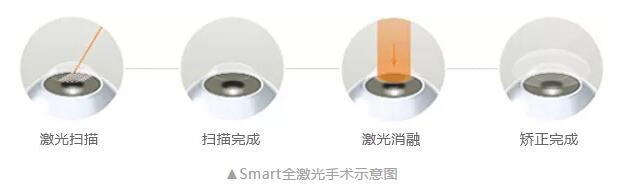 主流近视手术包含全飞秒激光手术、Smart全激光手术、半飞秒激光手术、晶体植入手术2.jpg