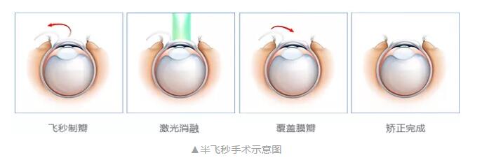 主流近视手术包含全飞秒激光手术、Smart全激光手术、半飞秒激光手术、晶体植入手术3.jpg