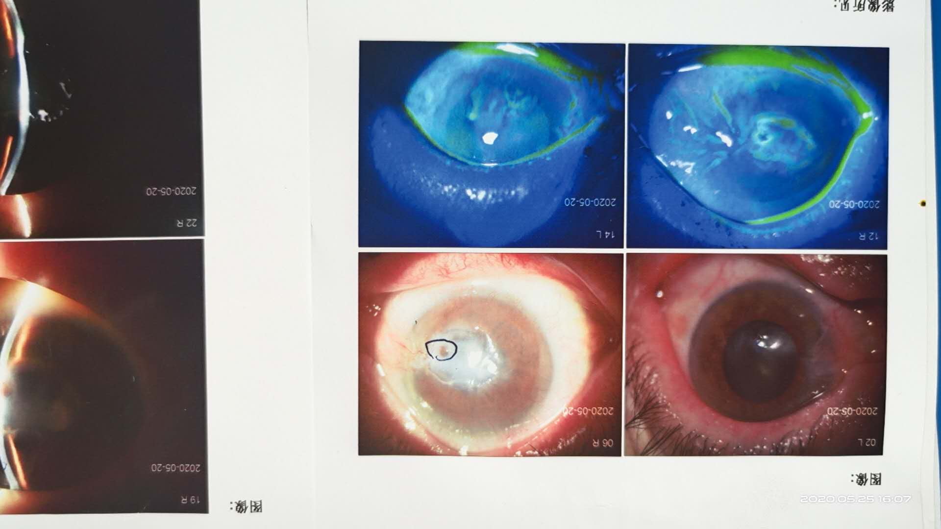 角膜移植排斥反应图片图片