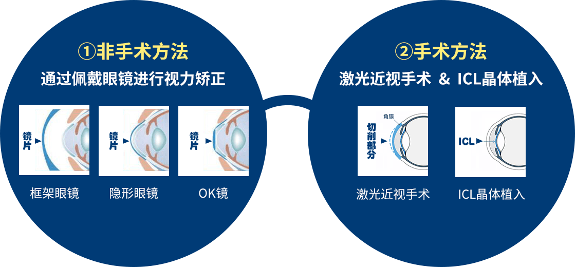 屈光矫正